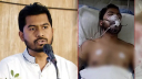 নুরের নাকের হাড় ভাঙায় সুস্থ হতে আরো কয়েক সপ্তাহ লাগবে