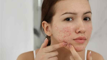 বয়স্কদেরও ব্রণের সমস্যা হয় কেন? কারা সাবধান থাকবেন