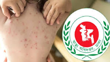 হাম উপসর্গে আরও ৭ জনের মৃত্যু