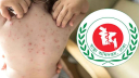 হাম উপসর্গে একদিনে আরও ৮ জনের মৃত্যু