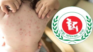 হাম উপসর্গে একদিনে আরও ৭ শিশুর মৃত্যু