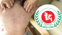 হাম উপসর্গে একদিনে আরও ৭ শিশুর মৃত্যু