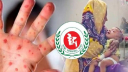 একদিনে হাম উপসর্গে আরও ৪ শিশুর মৃত্যু