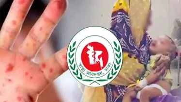 হাম ও উপসর্গে আরও ৪ জনের মৃত্যু