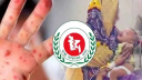 হাম ও উপসর্গে আরও ৪ জনের মৃত্যু