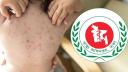 হামের উপসর্গে আরও ৮ শিশুর মৃত্যু