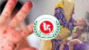 হাম উপসর্গে আরও ৭ শিশুর মৃত্যু
