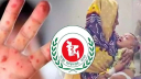 হাম ও উপসর্গে থামছেই না প্রাণহানি, মৃত্যুর সংখ্যা ১০০০ ছুঁই ছুঁই