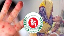 হাম উপসর্গে আরো ৭ জনের মৃত্যু