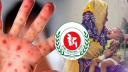 হামের উপসর্গে আরও ৮ শিশুর মৃত্যু