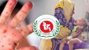 হামের উপসর্গ নিয়ে আরও ৬ শিশুর মৃত্যু