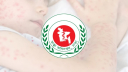 হামের উপসর্গে আরও ৫ শিশুর মৃত্যু