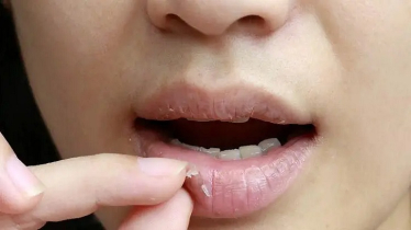 সারা বছরই ঠোঁট ফাটে? কোনো রোগের লক্ষণ নয় তো
