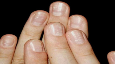 নখ দেখে স্বাস্থ্য বোঝার উপায়: কোন লক্ষণ কীসের ইঙ্গিত?
