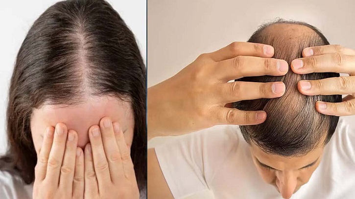 অল্প বয়সে চুল পড়ার কারণ ও চিকিৎসা