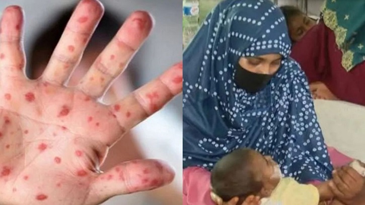 হামের উপসর্গে গত ২৪ ঘণ্টায় ৪ শিশু মারা গেছে