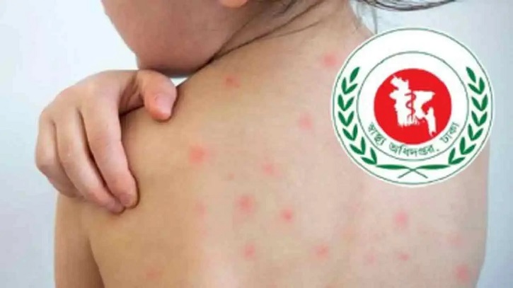 হাম ও হামের উপসর্গে নিহত ১২০০ ছাড়াল