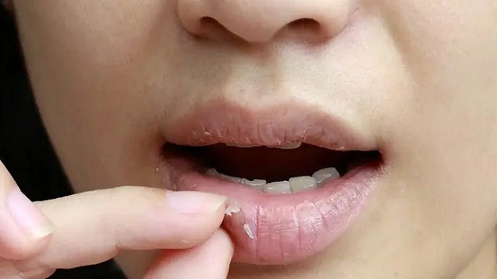 সারা বছরই ঠোঁট ফাটে? কোনো রোগের লক্ষণ নয় তো
